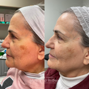 Banish Sun Spots: The Power of IPL Treatments for Sun-Damaged Skin