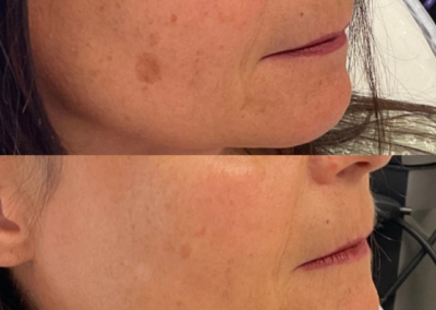 Before and After IPL for Sun Spot Removal Boise ID