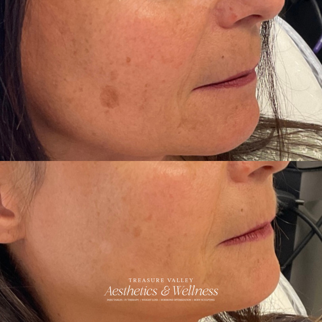 Before and After IPL for Sun Spot Removal Boise ID