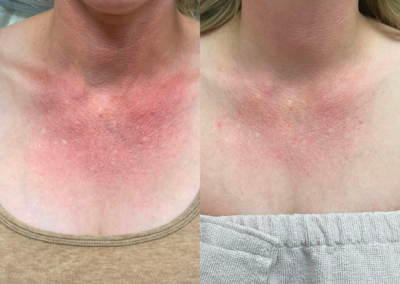 Age Spot Removal Secrets: How IPL Turns Back the Clock on Your Skin