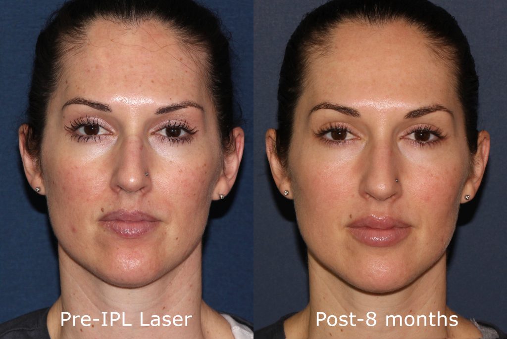 ipl skin tightening before and after