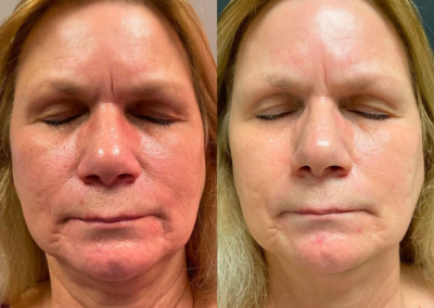 IPL for Skin Tightening: Unlock the Secret to Firmer, Younger-Looking Skin