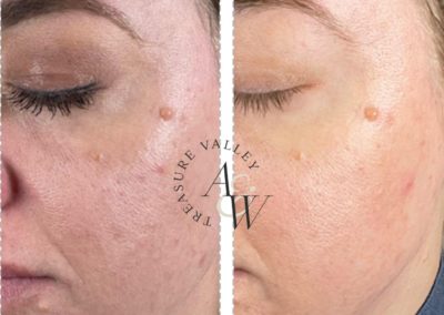 What Is Plasma Skin Tightening?