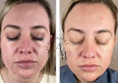 What Is Plasma Skin Resurfacing and Scar Revision?