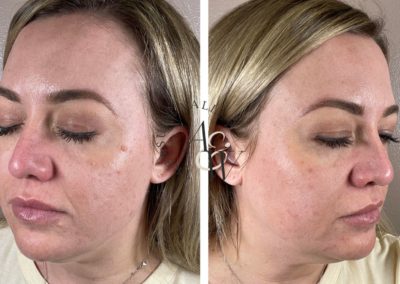 What Is Plasma Skin Resurfacing and Scar Revision?