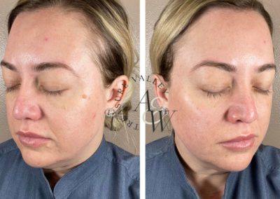 What Is Plasma Skin Resurfacing and Scar Revision?