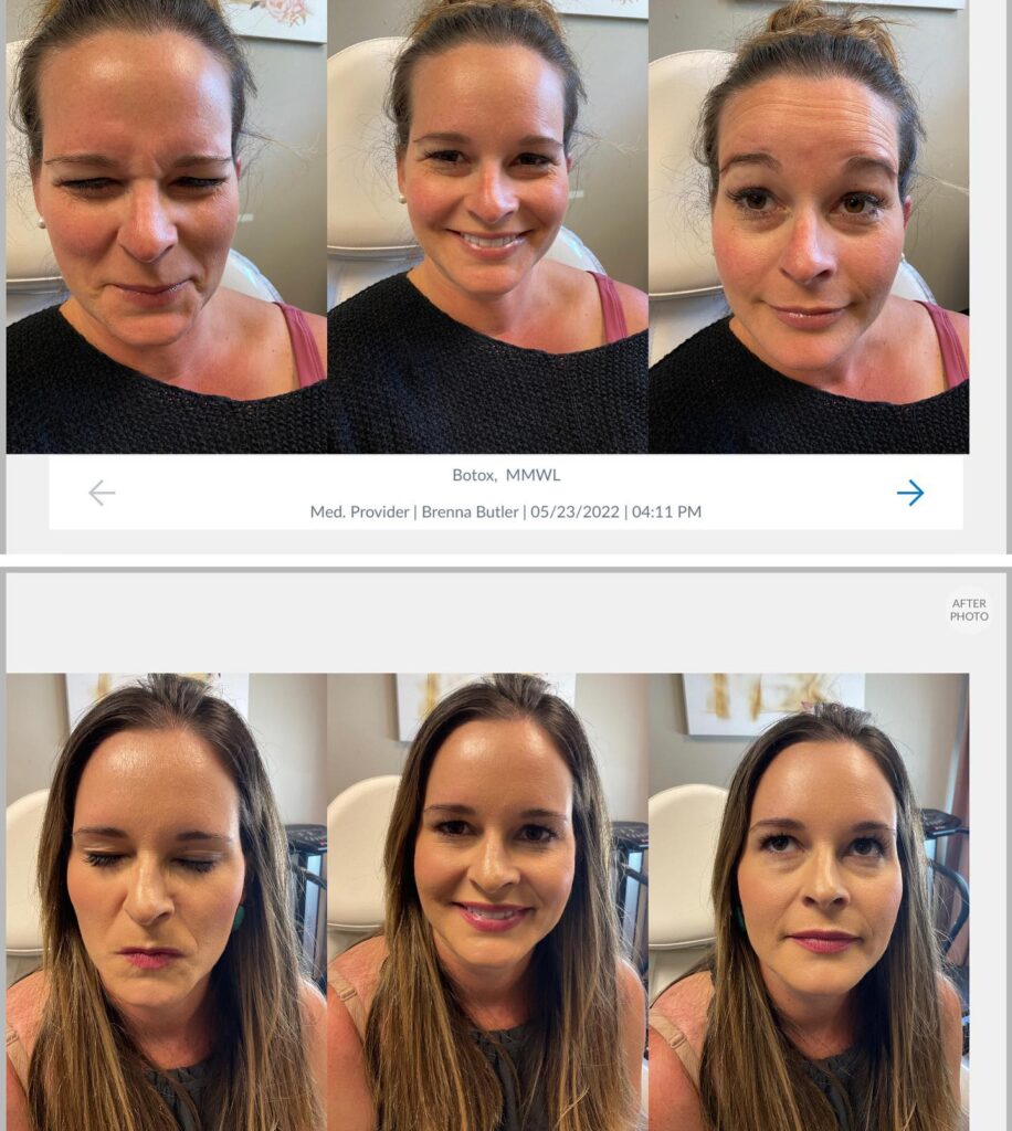 Wrinkle Relaxers (Botox) in Boise, ID