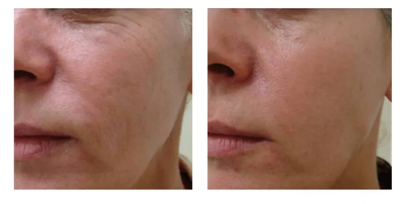 Before and After Image: ClearLift - left-front-oblique