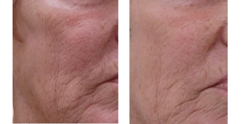 Before and After Image: ClearLift - right-front-oblique