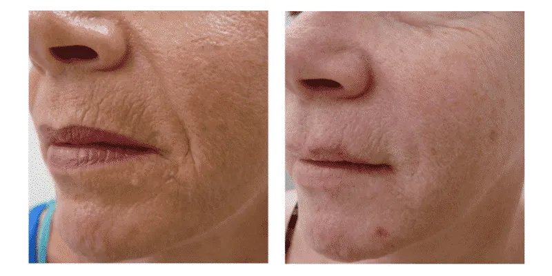 Before and After Image: ClearLift - left-front-oblique