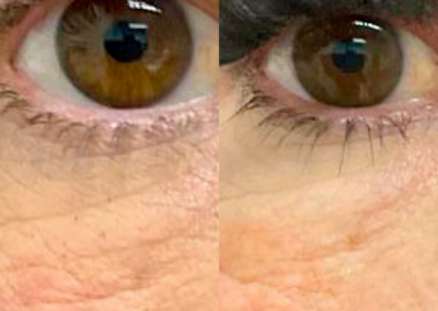 What Is Plasma Skin Tightening?