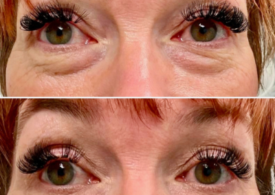 What Is Plasma Skin Tightening?