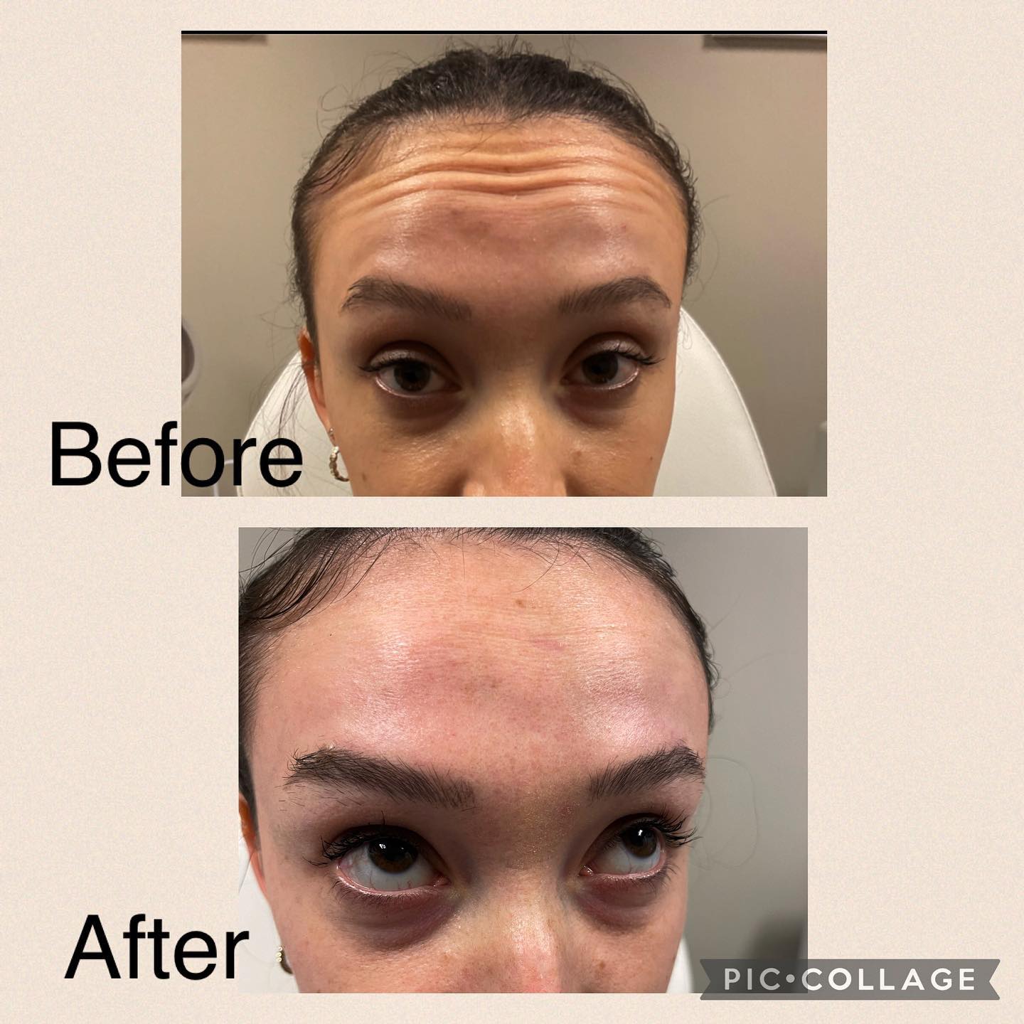 Before and After Image: Botox - front
