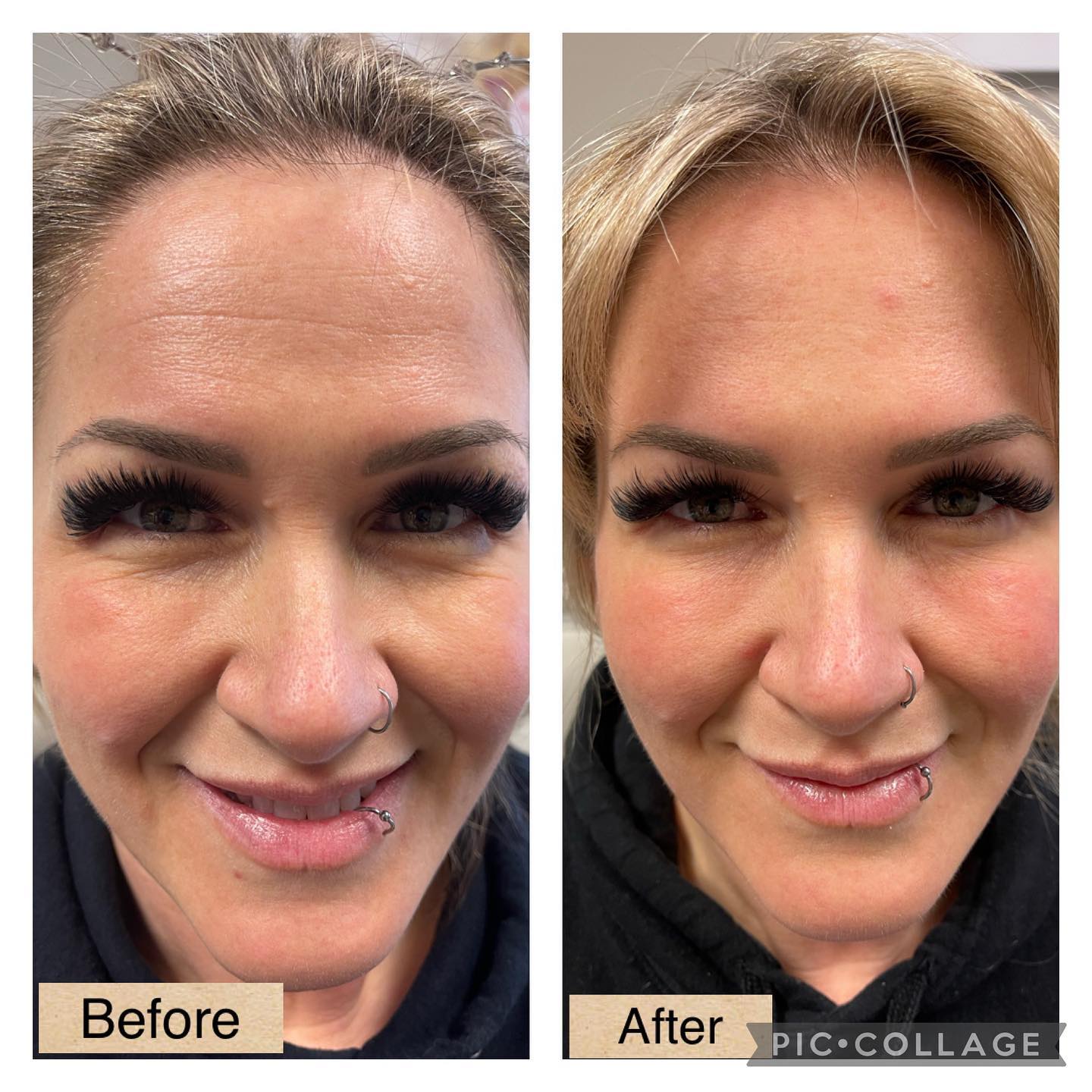 Before and After Image: Botox - front