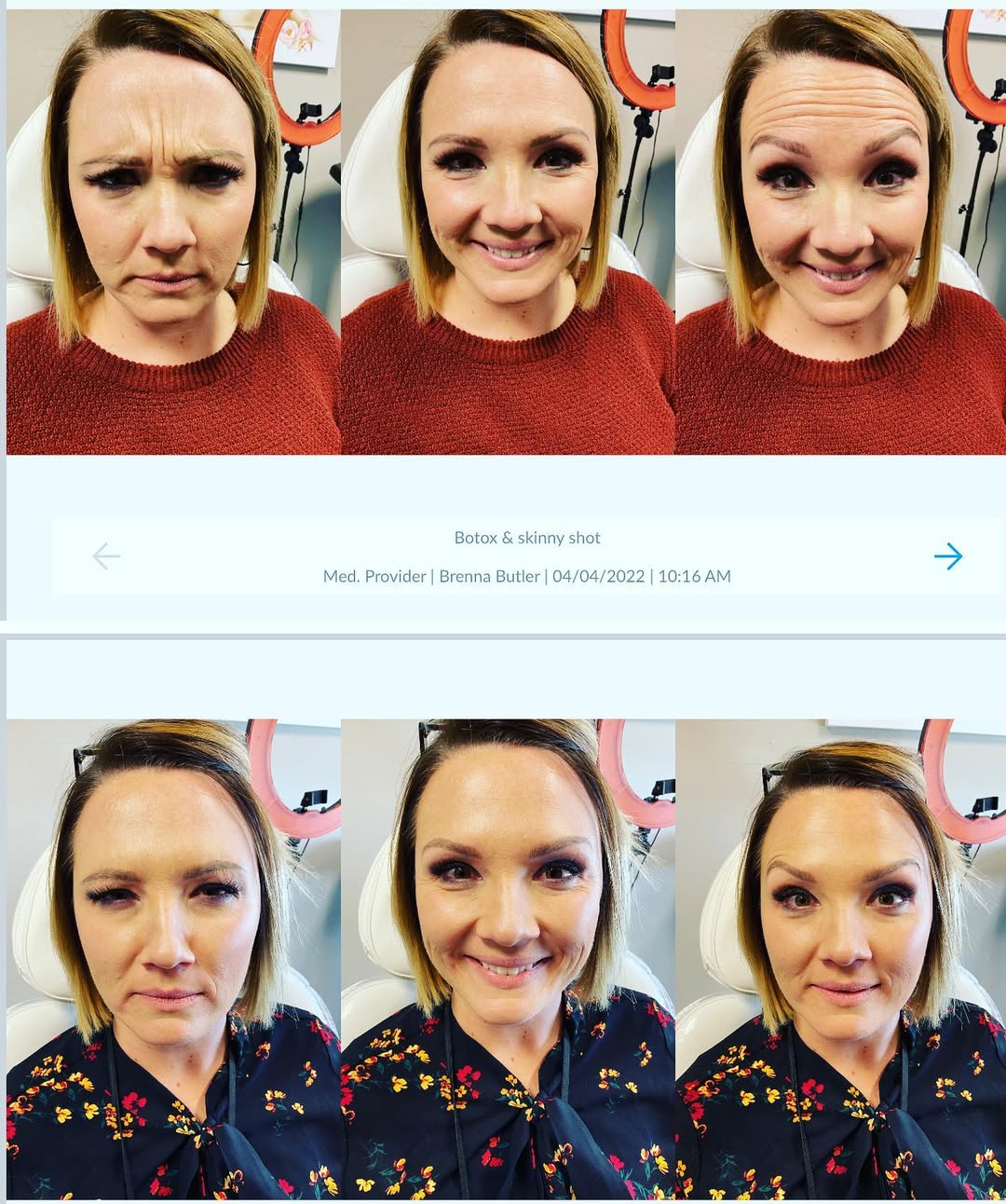 Before and After Image: Botox & Skinny Shot - front