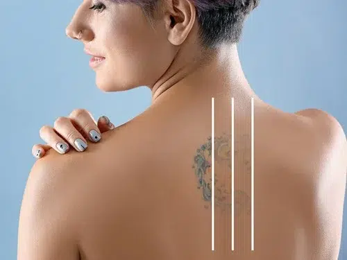 Laser Tattoo Removal in Boise